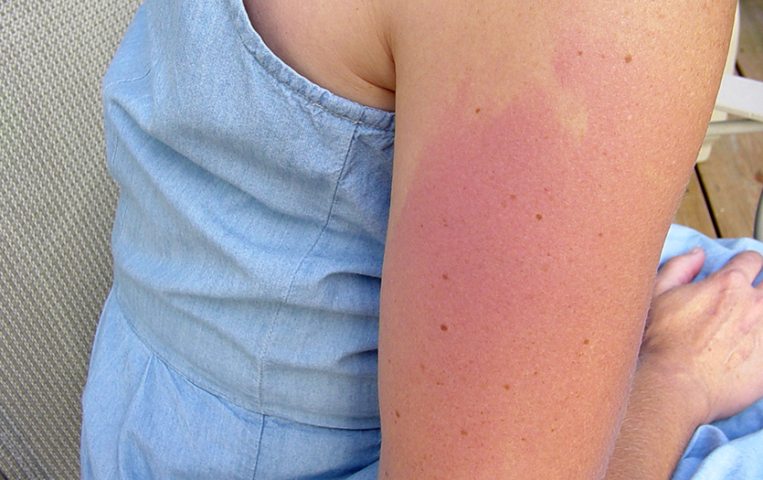 Person arm with rash