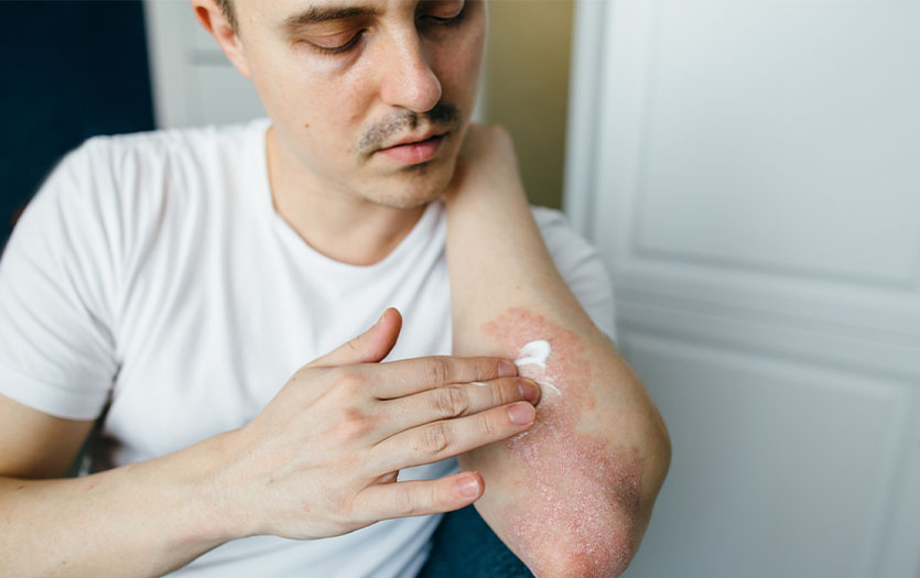 Man applying cream to rash