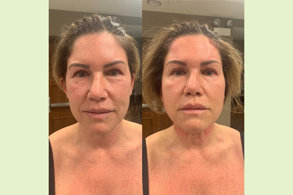 threading face before and after
