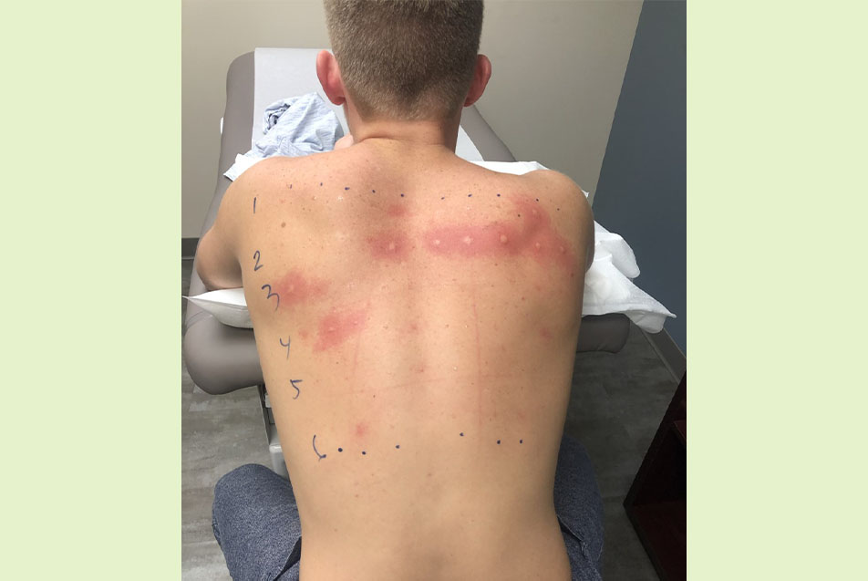 Allergy testing