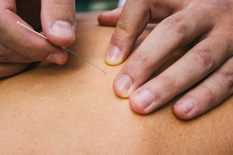 Need relief from pain? You could use a good needling