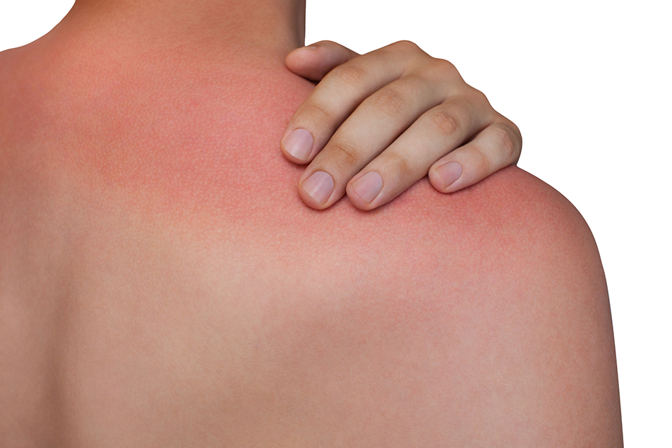 Natural Remedies To Treat Sunburn By Expert